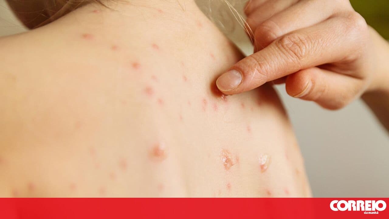 Three cases of measles and over 500 high-risk contacts in Beja