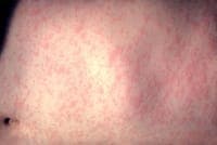 Portugal confirms nine measles cases since the start of the year