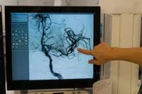 Portuguese researchers study method to identify risk of cognitive deficit after stroke
