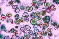 Health Authorities Confirm Five New Measles Cases in Lisbon Area