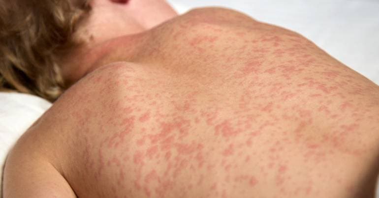 Portugal recorded 20 cases of measles since the beginning of the year