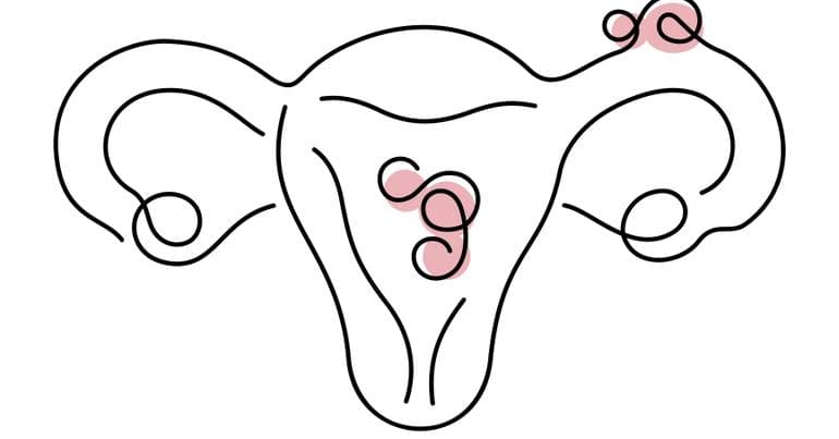 What is endometriosis?