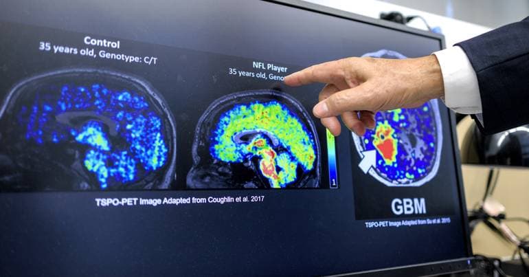 Error in brain cleaning may be a cause of Alzheimer's and ALS
