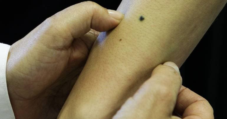 Researchers create innovative hydrogel to treat melanoma